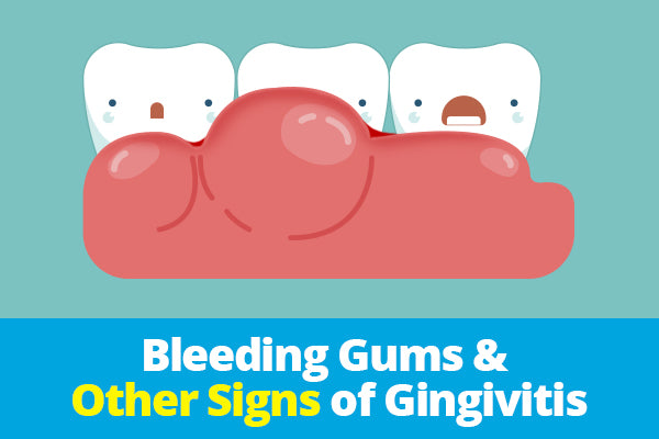 bleeding gums gingivitis logo