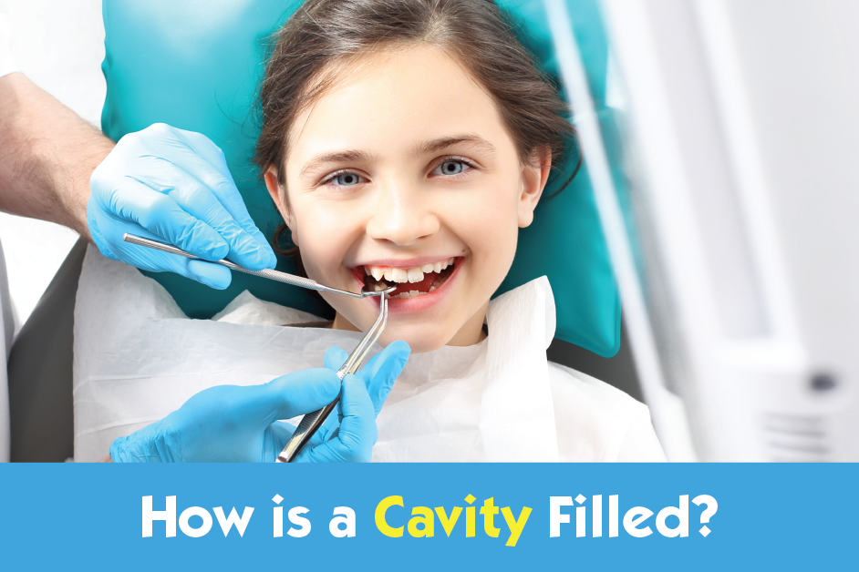 How is a cavity filled?