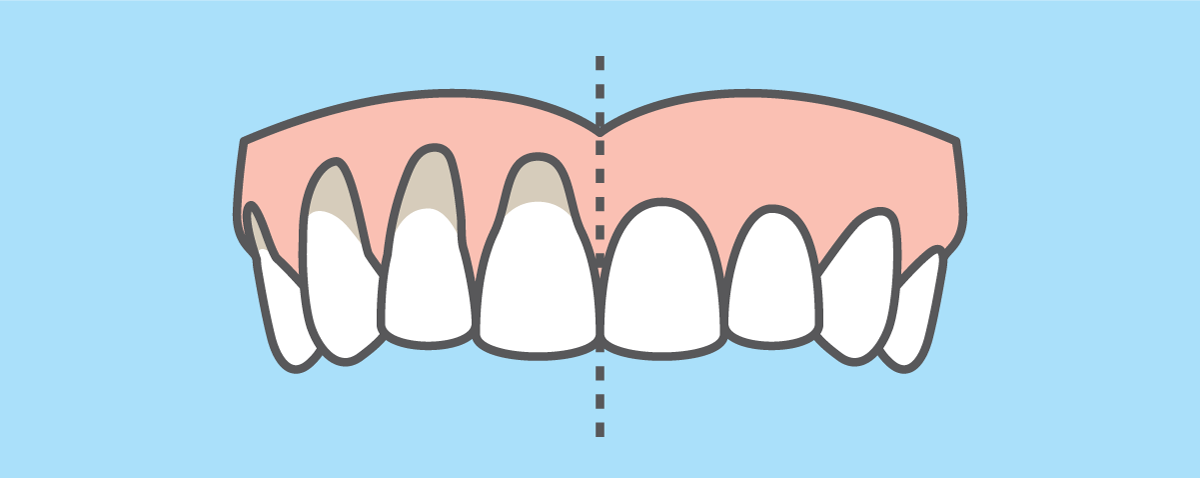 comparison illustration of a mouth with periodontal disease and receeded gums versus healthy gums